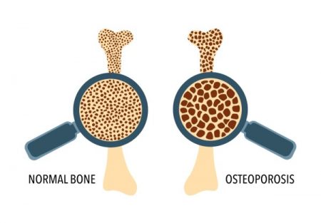 normal bone and osteoporosis bone